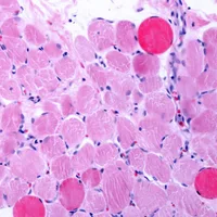 STAT+: Next-gen Duchenne drug from Entrada disappoints