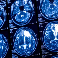 Even light drinking combined with aging is linked to reduced brain blood flow and thinner tissue