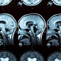 Everyday infections, not vaccines, are linked to an increased risk of childhood stroke