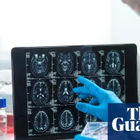 Slow Alzheimer’s diagnoses ‘mean UK patients missing out on experimental treatments’